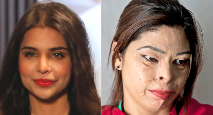 Красавицы Пакистана. К сожалению, бывшие... Частнопрактикующий пластический хирург Асим Шахмалак руководит клиникой по пересадке волос, расположенной около аэропорта Манчестера. Он взял на себя расходы и труд пересадить жертвам насилия волосы, брови и ресницы, а также обожженые кислотой кожу лица и шеи. женщины, Пакистан, насилие, пластический хирург