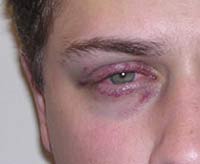 Синяк под глазом помог раскрыть измену мужа