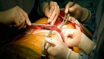 Пересадка органов: страхи реальные и мнимые 